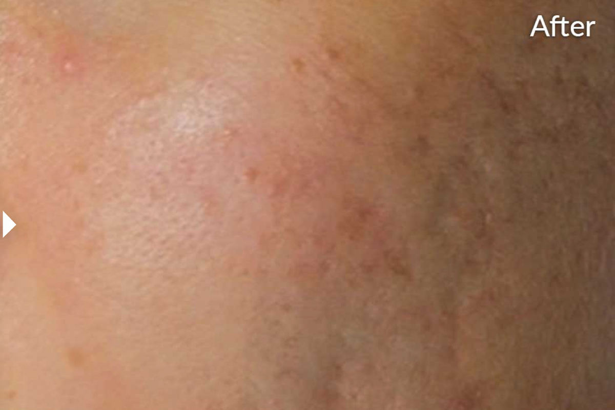 Scars look less noticable after SkinPen Microneedling in Shelby Township